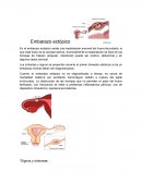 Embarazo ectópico. Signos y síntomas