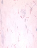 ¿Hablar de Tuberculosis es remontarse al pasado?