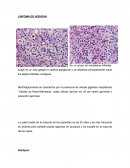 LINFOMA DE HODGKIN