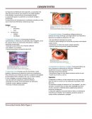 Conjuntivitis aguda.