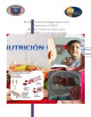 Anemia por déficit de hierro.