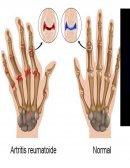 Enfermedad ARTRITIS REUMATOIDE