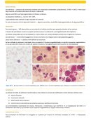 ANEMIA MEGALOBLASTICA.