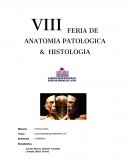 Ostiogenesis imperfecta (OI)