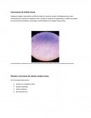 Carcinomas de células claras.