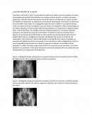 CASOS LUXACIÓN DE CADERA