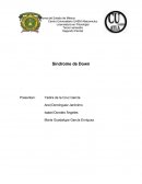 Síndrome de Down, también conocido como trisomía 21 .