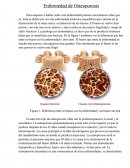 Enfermedad de Osteoporosis
