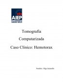Tomografía Computarizada Caso Clínico: Hemotorax
