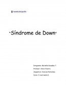 “Síndrome de Down”