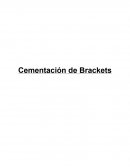 Cementacion de brackets