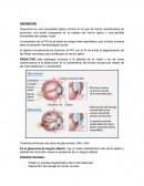 Glaucoma es una neuropatía óptica