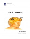 Tumor cerebral ¿Qué es el tumor cerebral?