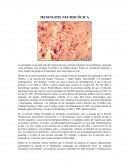 Meningitis neumocócica