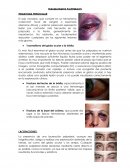 TRAUMATISMOS PALPEBRALES HEMATOMA PERIOCULAR