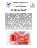 Cancer del colon