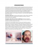 TIPOS DE HEMANGIOMAS
