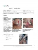 Uso de cementos quirúrgicos en onicocriptosis