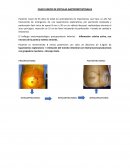 CASO CLINICO DE FÍSTULAS GASTROINTESTINALES