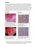 Carcinoma pulmonar