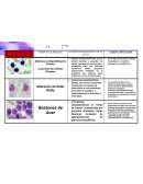 Alteración morfológica de la célula. Síndrome Linfoproliferativo Crónico