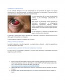 Hemorragia Subconjuntival