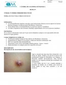 HISTIOCITOMA FIBROSO BENIGNO